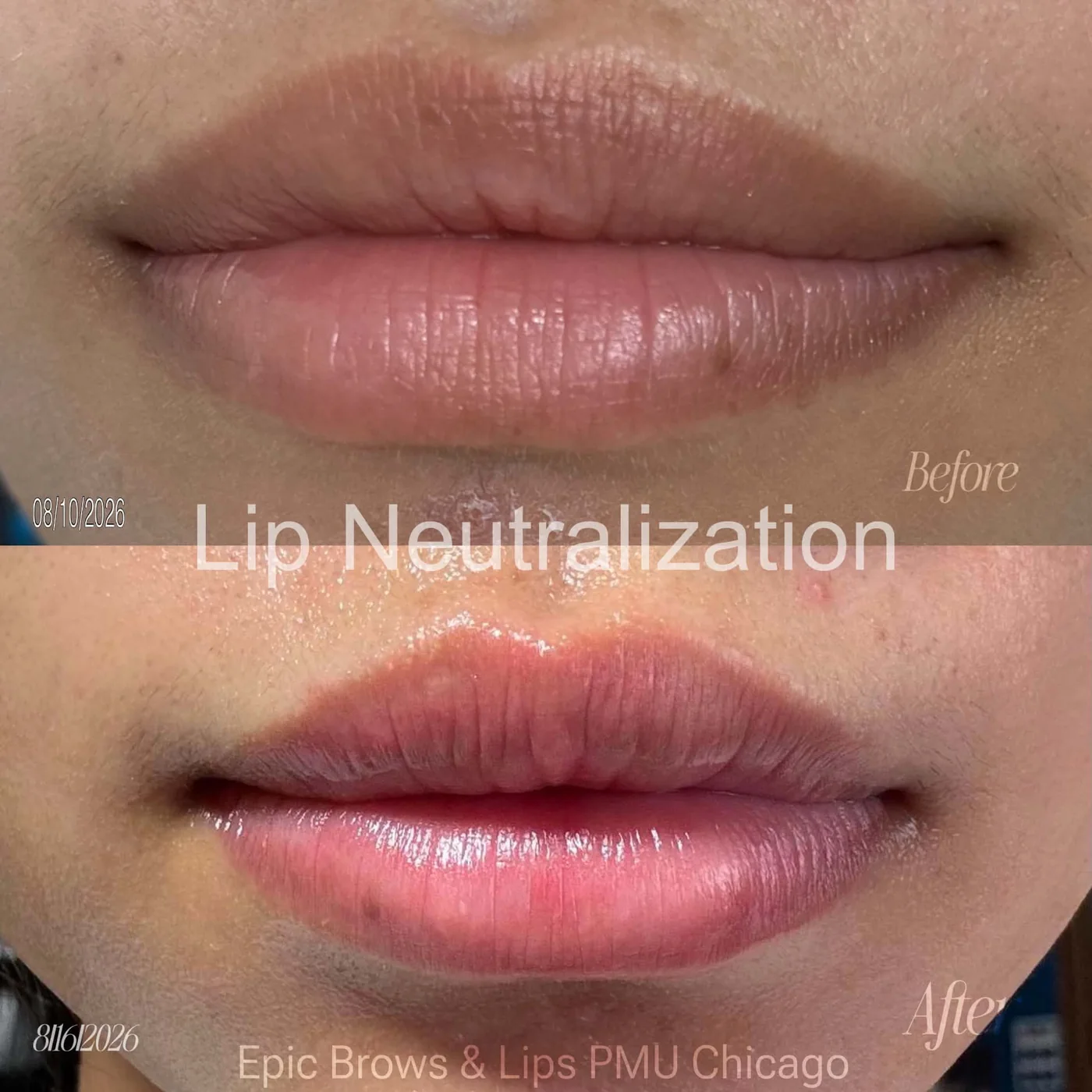 Lip Neutralization Result