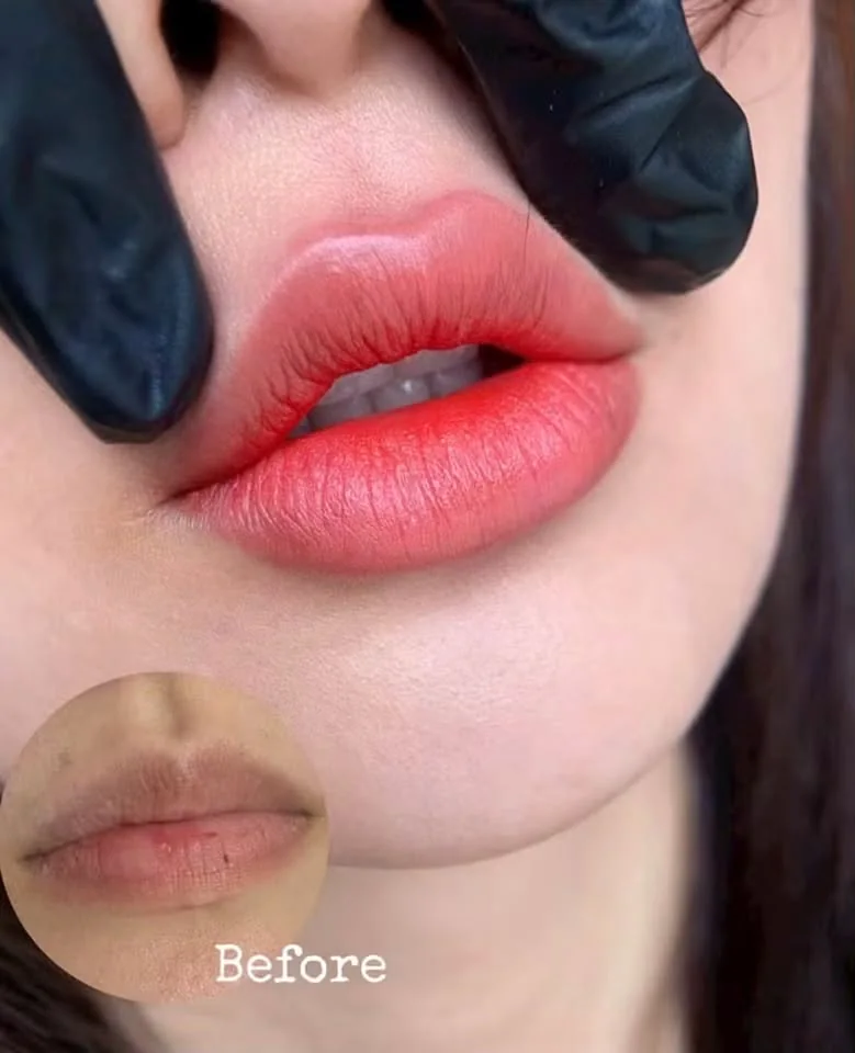 Lip Treatment Before & After