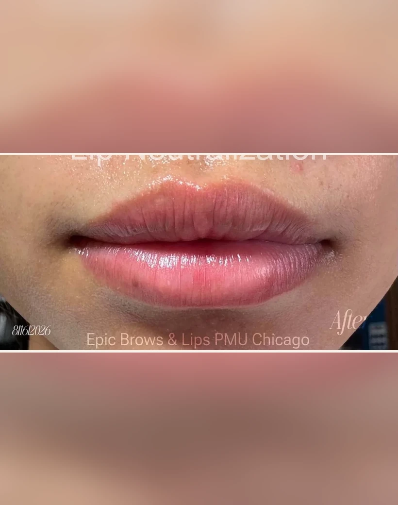 After: Lip Neutralization