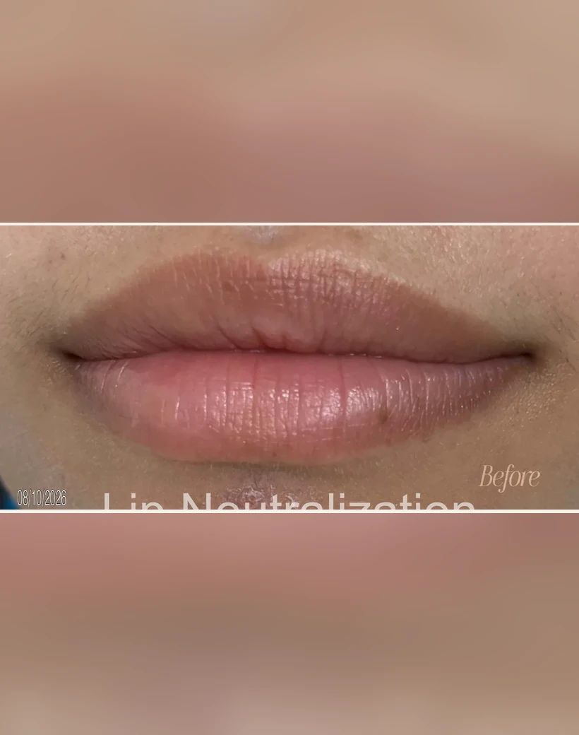Before: Lip Neutralization